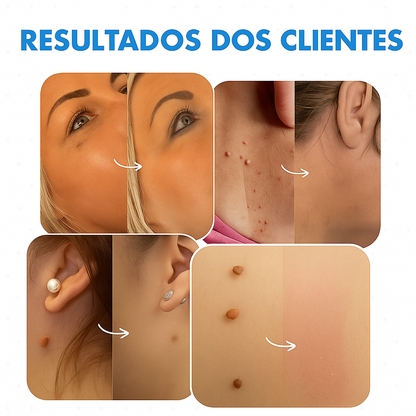 Sem verrugas - O removedor de verrugas com haste