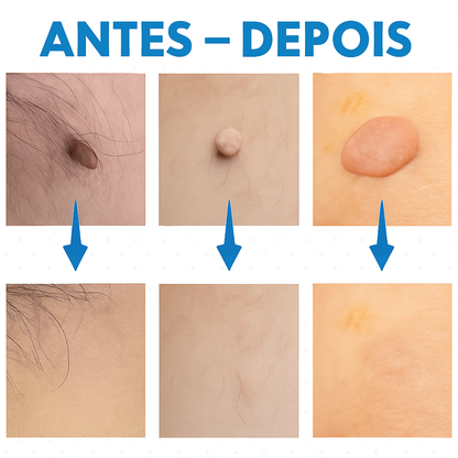 Sem verrugas - O removedor de verrugas com haste